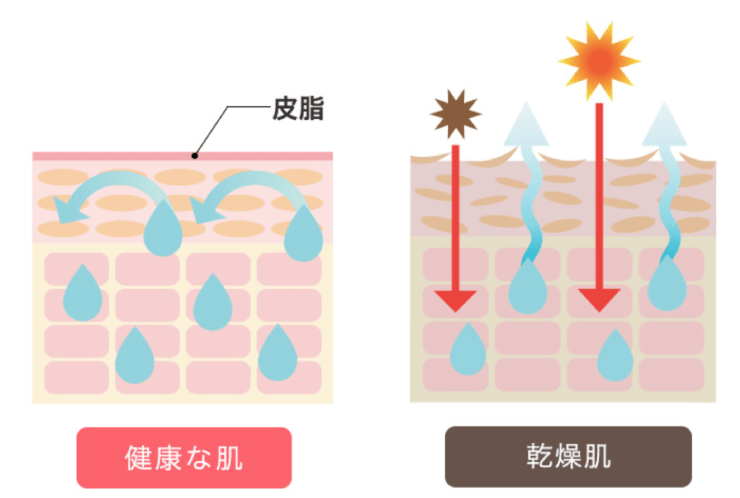 乾燥肌と健康な肌のイラスト