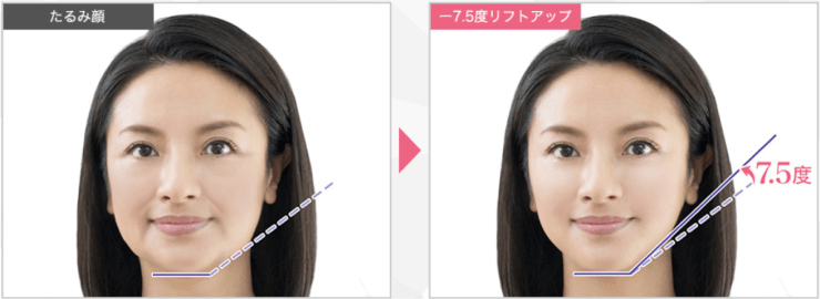 たるみやほうれい線が変わると印象が変わる